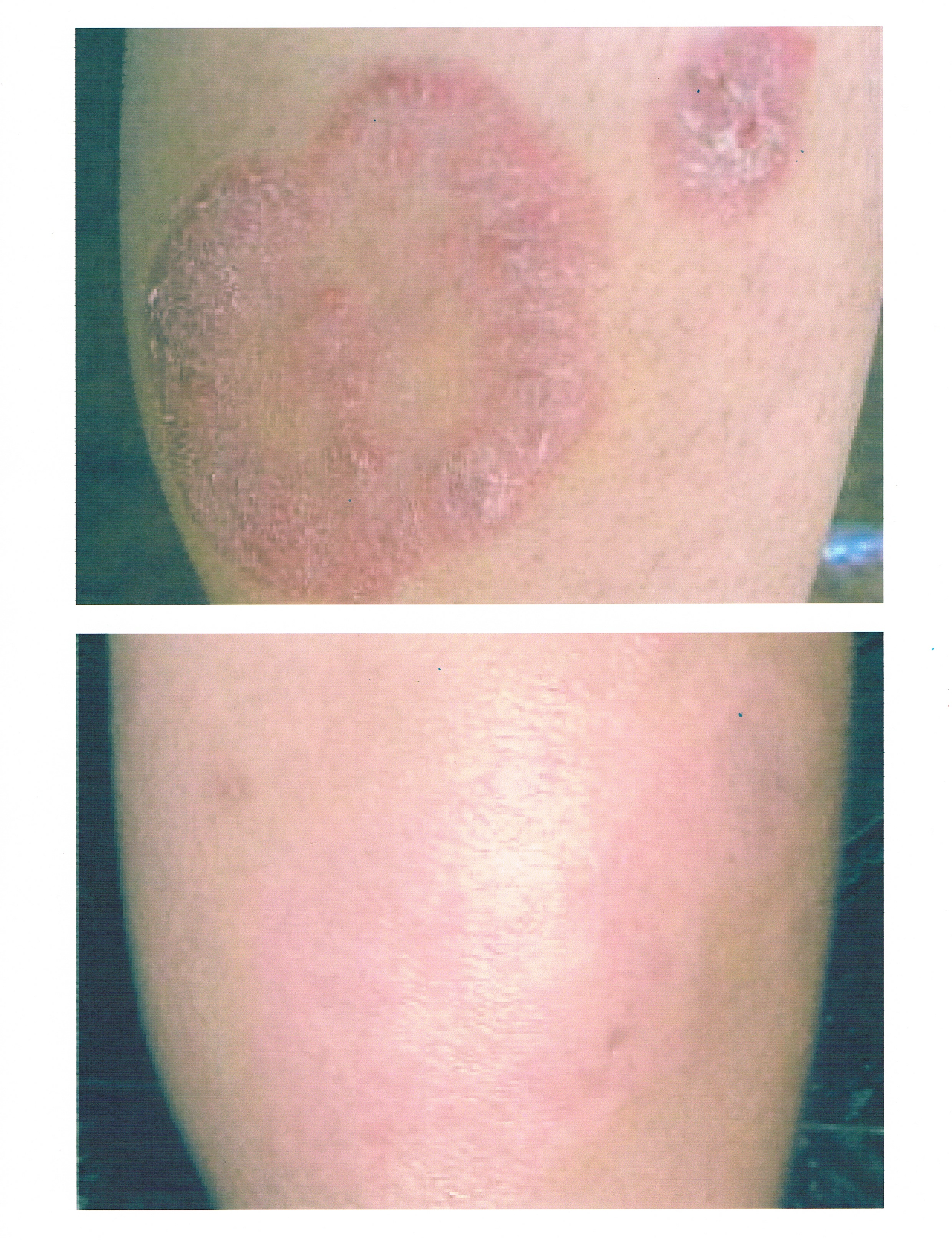 eczema inside elbow